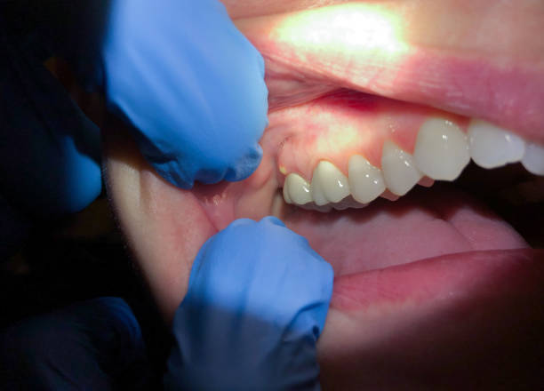 Best Emergency Treatment for Dental Infections or Abscesses in King City, OR